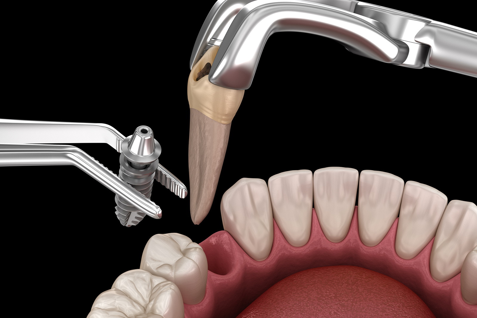 1日で噛める歯が入る「抜歯即時荷重」